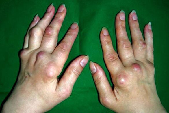 Рацете погодени од полиостеоартритис деформанс