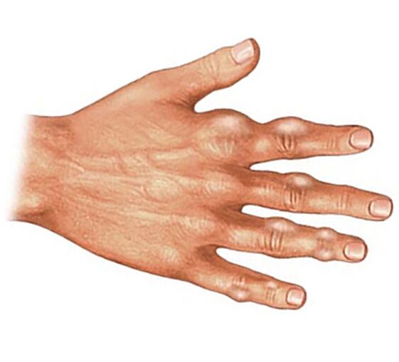 Таложење на кристали на урична киселина во меките ткива на прстите со гихтичен артритис