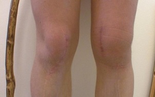 фази на развој на артроза на колената