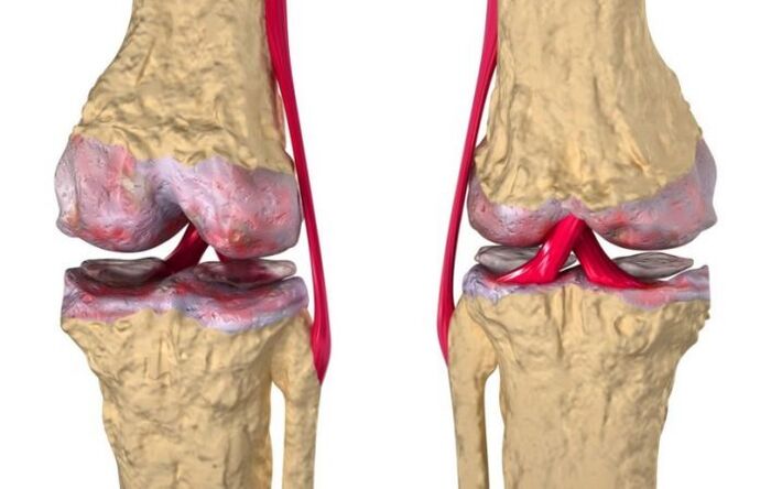 Артроза на коленото зглоб