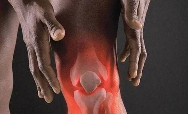 Артрозата е придружена со воспалителен процес во коленото зглоб